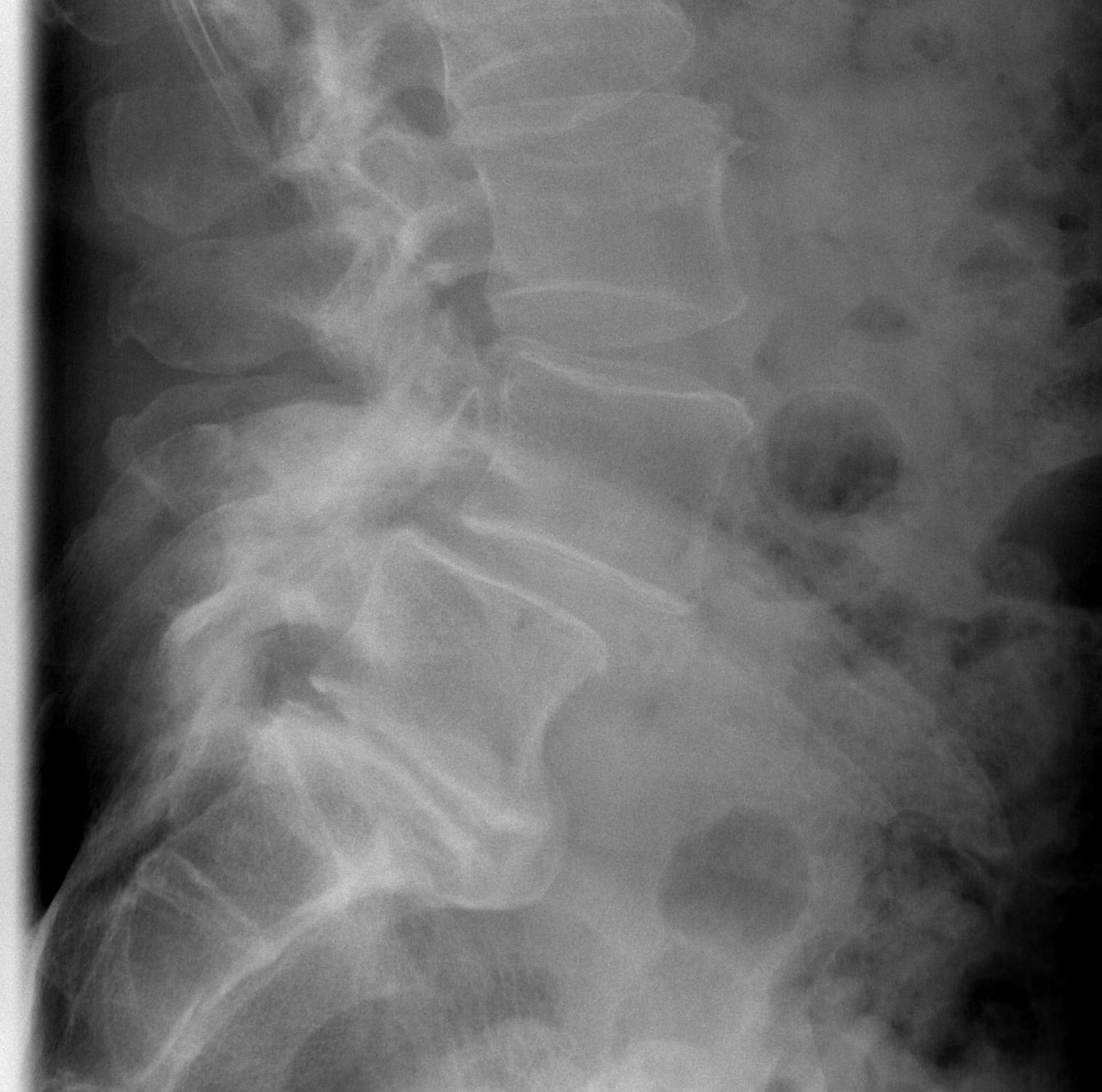 Spondylolithesis L4/5